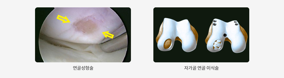 왼쪽부터 연골성형술, 자가골 연골 이식술