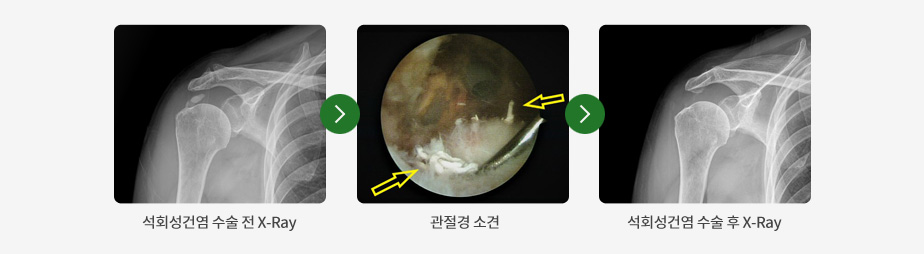 왼쪽부터 석회성건염 수술 전 X-Ray, 수술 관절경, 석회성건염 수술 후 X-Ray